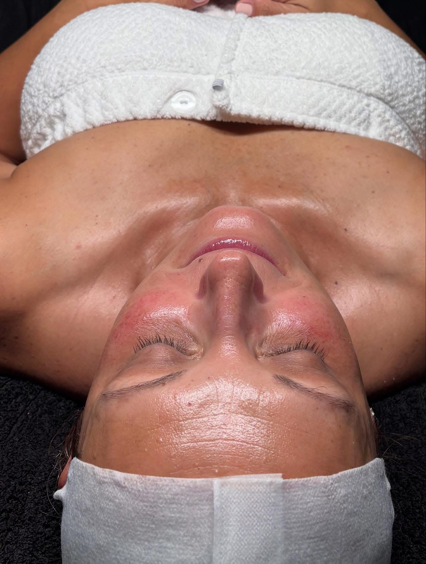 Skin redness and irritation caused by harsh over-the-counter acne products
